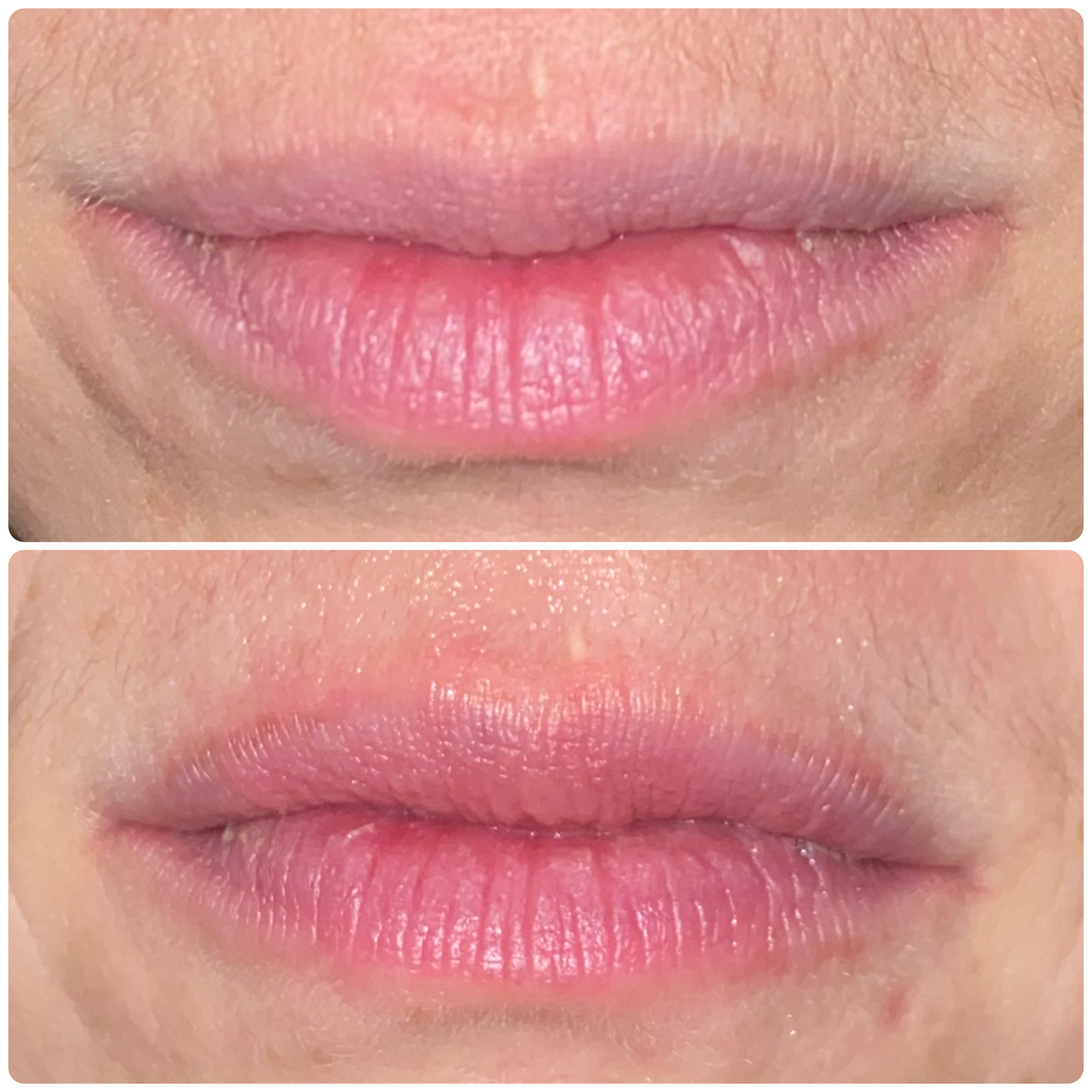 Diamondstick Hyaluron Filler